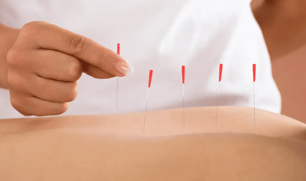 How Often Should You Get Dry Needling?