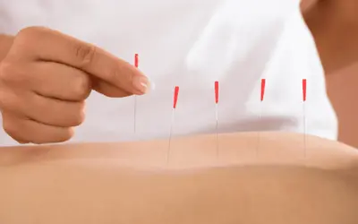 How Often Should You Get Dry Needling? What Patients Need to Know