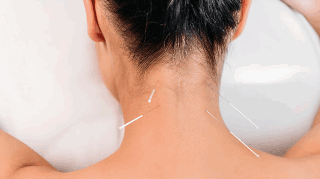 Can Dry Needling Make Pain Worse